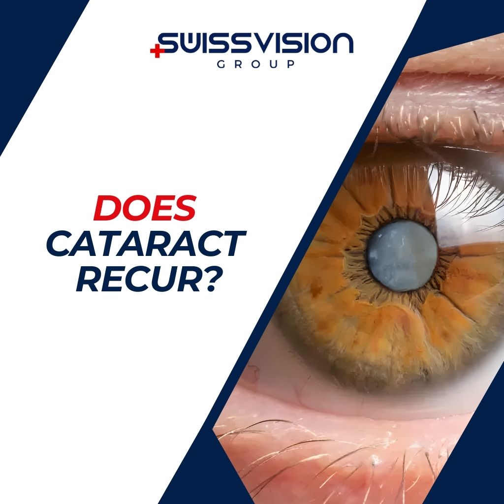 Does Cataract Recur