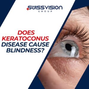 Does Keratoconus Disease Cause Blindness 2