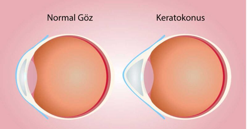 keratokonus hastalığı körlüğe neden olabilir mi?