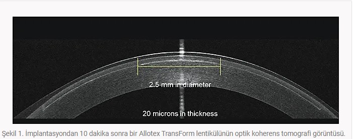 Allograft Corneal Inlay