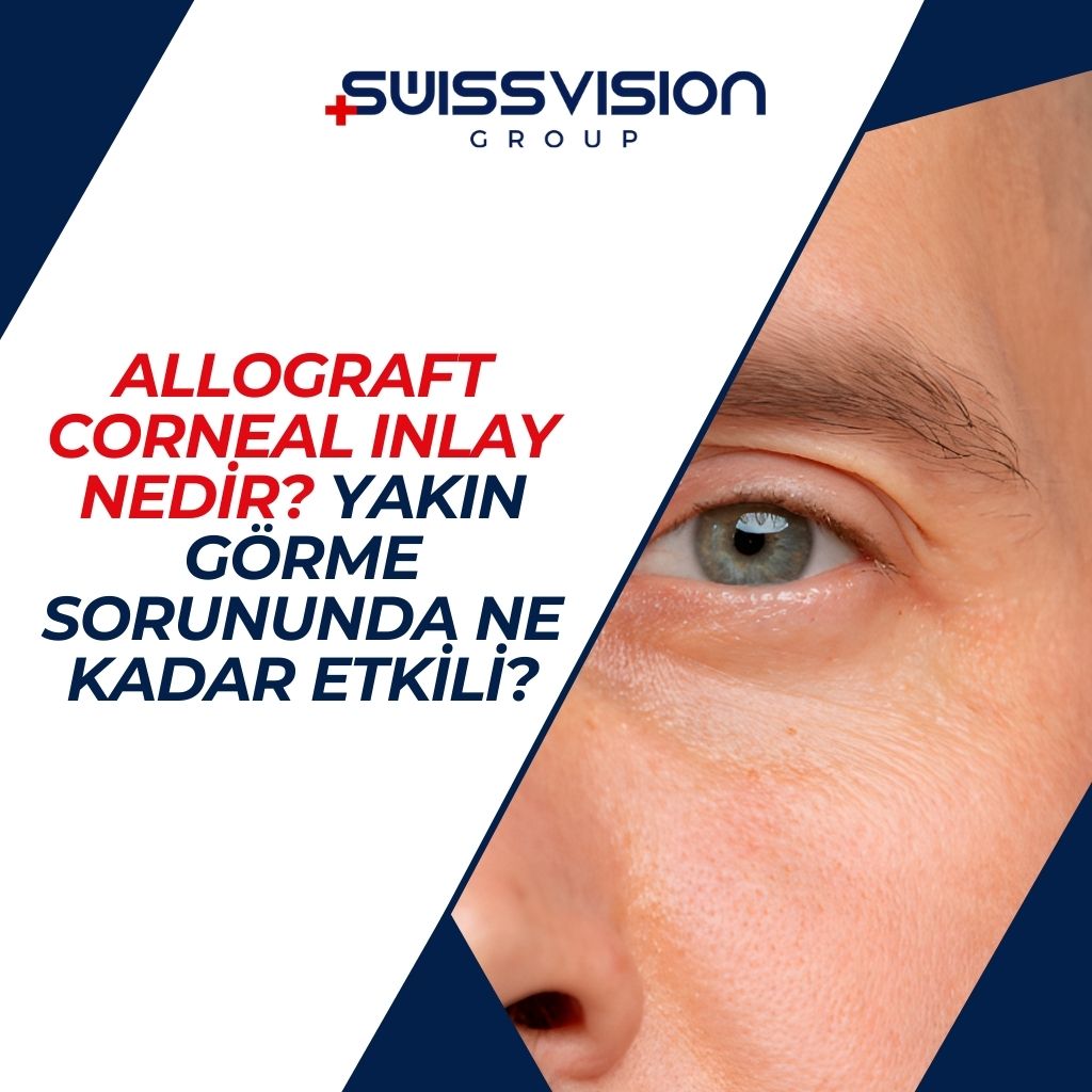 Allograft Corneal Inlay Nedir Yakin Gorme Sorununda Ne Kadar Etkili